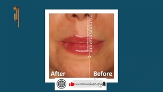 تزریق ژل لب طبیعی و زیبا