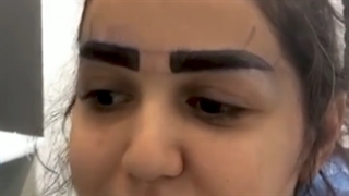 کاشت ابرو در تهران