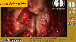 مننژیوم ‌شیار بویایی بسیار بزرگ