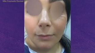 عمل سانترال لب بلافاصله بعد از عمل بینی