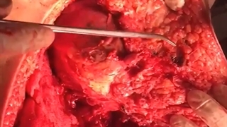 جراحی بیمار مبتلا به استئوسارکوم