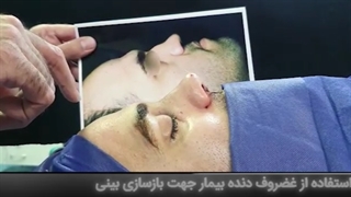 بازسازی بینی با غضروف دنده توسط دکتر ابراهیمی