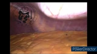 کیسه صفرا سمت چپ