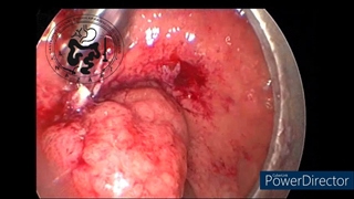 برداشتن پولیپ رکتوم بطریقه آندوسکوپیک بروشTEM