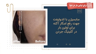 سابسیژن با اندولیفت برای رفع اسکار آکنه و جای جوش