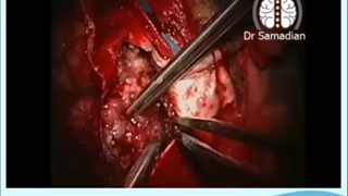 تشنج مداوم در اندام تحتانی راست (تشنج فوکال )