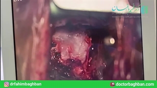 تومور مننژیومای تمپورال چپ