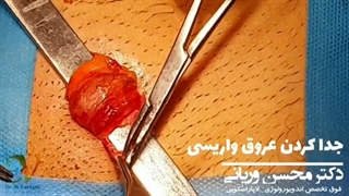 فیلم جراحی واریکوسل