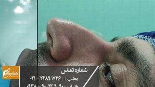 جراحی زیبایی بینی با نتیجه ای طبیعی