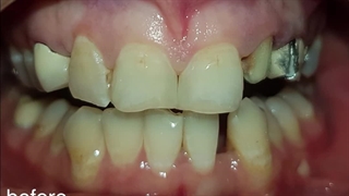 بهترین روکش و لمینت دندان (دکتر یلدا بازرگان)۰۲۱۲۲۲۲۰۰۰۰