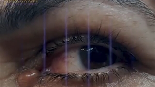 یک هفته بعد برداشتن توده گوشه چشم با چسبندگی مجرای اشکی و توده لبه بالا چشم راست