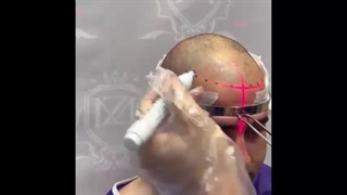 کاشت از بانک مو، بدون عوارض کاشت مو