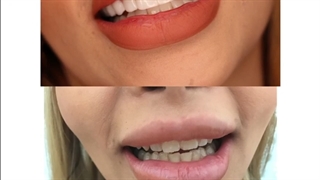 فیلم واقعی کامپوزیت ونیر دو فک برداشتن خال گوشتی