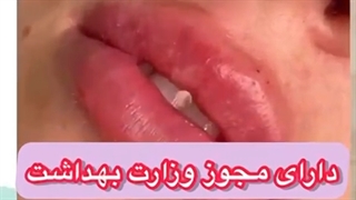 فیلر لب ریوانس