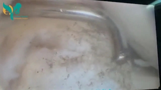 جراحی پارگی رباط صلیبی