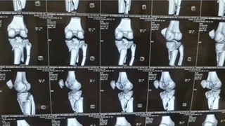 خردشدگی شدید زانو