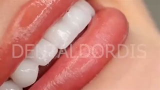 نمونه کار های کامپوزیت دندان