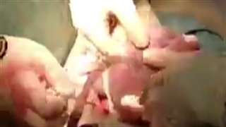 نحوه به دنیا آمدن پنج قلو ها