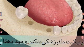 کلینیک دندان پزشکی دکتر وحید دهقان: ایمپلنت بر پایه بریج