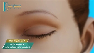 چه کسانی کاندید عمل بلفاروپلاستی هستند؟| دکتر کامبیز ایزدپناه