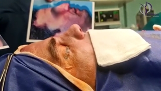 جراحی زیبایی رینوپلاستی مردانه