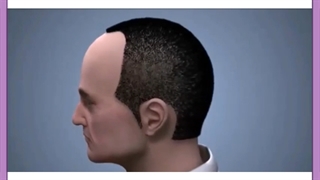 مراحل، مزایا و هزینه کاشت مو به روش SUPER FUE