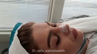نحوه چسب زدن پس از عمل بینی