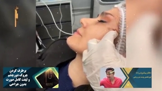 رفع کامل چین و چروک دور چشم بدون جراحی