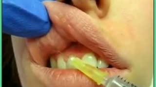 راهکار قطعی از بین بردن خط خنده با تزریق ژل لمینت