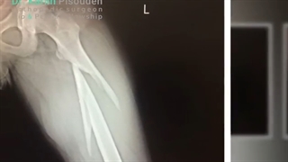 شکستگی ناحیه ساب تروک بر اثر تصادف