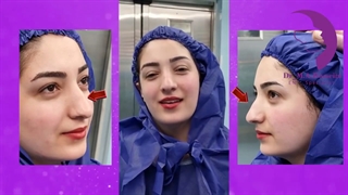 جراحی بینی گوشتی قبل و بعد | دکتر محمدعلی حسینی_ اهواز اکستنشن تاج دندان