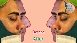 جراحی بینی مردانه