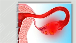 علل برداشتن رحم(هیسترکتومی)
