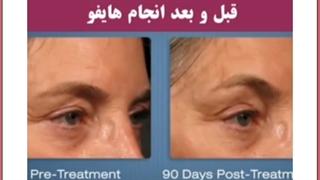 هایفوتراپی معجزه جوانسازی و لیفت صورت | هزینه و مزایا آکنه