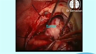 عمل جراحی تومور مننژیوم