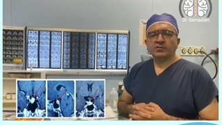 عمل جراحی اندوسکوپی ادنوم هیپوفیز - آکرومگالی