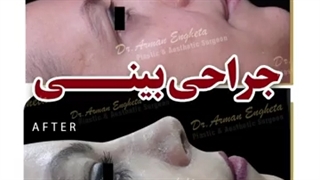 جراحی زیبایی بینی