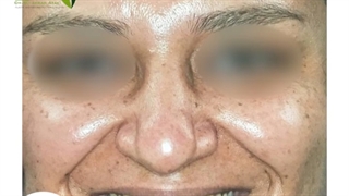 رینوپلاستی در بینی گوشتی