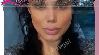نتیجه 9 ماه بعد از جراحی بینی