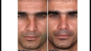 نمونه جراحی بینی مراجعه کننده‌ عزیزمون