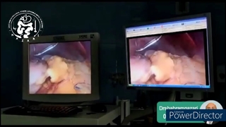 اسلیو گاسترکتومی و تغییرات هورمونی