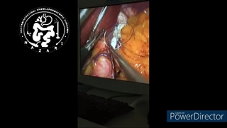 رودوزی سطوح منگنه(استاپلر) در عمل جراحی اسلیو معده