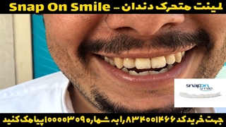 خرید لمینت متحرک دندان اسنپ آن اسمایل-09363660478