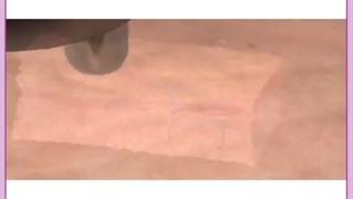 جوانسازی پوست صورت با لیزر آر اف فرکشنال(RF Fractional) اکستنشن تاج دندان