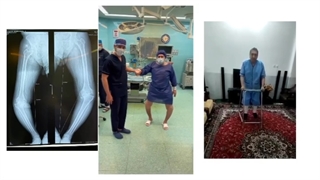 جراحی تعویض مفصل همزمان دو زانو در آقای 58 ساله