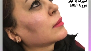زاویه سازی فک و کانتورینگ صورت