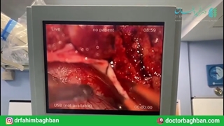 جراحی تومور سی پی انگل