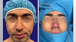 رینوپلاستی یا عمل زیبایی بینی | دکتر خوروش