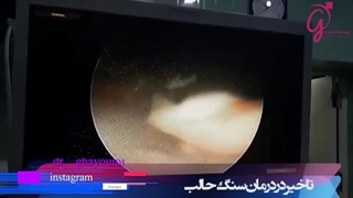 درمان سنگ حالب