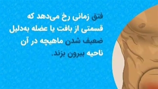 دلایل ایجاد فتق شکم